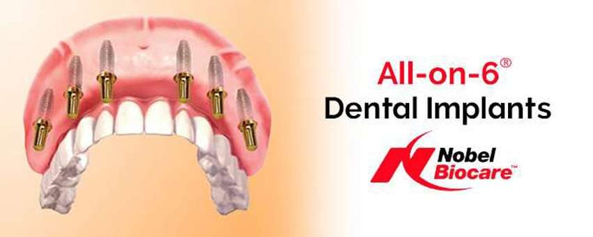 All on 6 Dental Implants